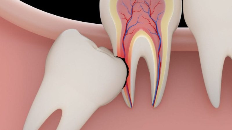 Know more about the best dentist wisdom tooth extraction in Singapore