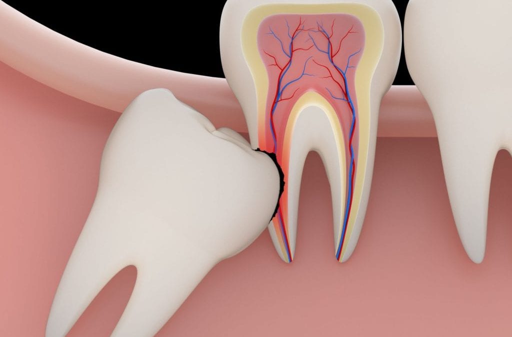 Know more about the best dentist wisdom tooth extraction in Singapore