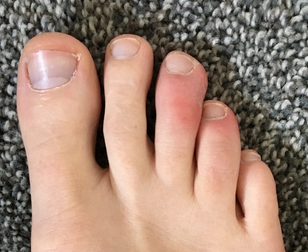 Chilblains
