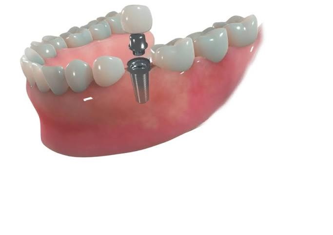 Dentist Supports